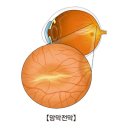 망막 전막(Epiretinal membrane) 눈 질환이란? 이미지