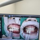 도화플러스치과의원 | [약속플러스치과] 평택 지제역 근처 치과 추천 / 미백 1회 후기