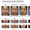 브이라인 네이버블로그