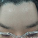분당 서현역 이마주름, 미간주름 자가진피재생술 행복한여우 3회차 시술 후기