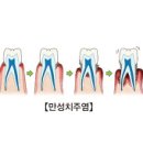 만성 치주염(풍치)이란 ? 이미지