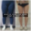 천안 365mc 허벅지 무한람스 후관리 체외충격파 람스황금기 4개월차 후기