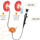 요로결석 원인 증상 통증 제거 복강경수술 예방 식이 이미지