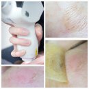 강남미인구제 | 강남 신논현 리팟레이저: 흑자레이저 흑자제거 전후비교 홈케어방법
