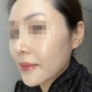 청량리 | 스킨부스터 리투오 효과! 청량리피부과 내돈내산 후기