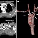 CS MED | Case_Study_441:무호흡증을 주소로 내원한 3주 된 여아_ Kommerell 게실