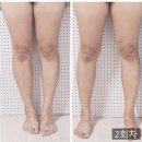 나온의원 | 동상이몽에도 나온 김윤아 다이어트의원 다녀온 후기!!