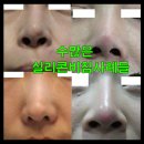 청담코지의원 | 코보형물제거 ,코실리콘제거 ,코끝연골제거 (귀,비중격) 수술알아보자구요