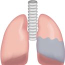 폐에 물이 차는 이유 폐부종 원인 예방법 치료법? 이미지