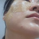 지에스25 일동센타점 | 편평사마귀, 1년 반 만에 250개 시술 후기