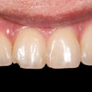 평촌이음치과의원 | [부산 명지 치과] "악! 젓가락 씹었어요" 앞니 깨짐, 티 안 나게 당일 복구한 후기 (ft. 레진 장인)