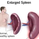 비장비대증 및 (비장 기능, 위치, 통증) 이미지