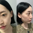 리모성형외과 눈밑지방재배치 내돈내산 리얼후기