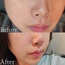 논현1-118 | 서울 강남 신논현역 피부관리 보름달뷰티 강남 논현본점 블랙헤드 후기