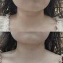 얀클리닉 벨르넥 후기 | 목주름 필러 시술·목주름레이저 1회차 리얼 후기