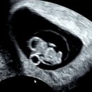 신미선 | [임신 8w2d] 임신 8주2일차, 아기 초음파 팔다리 보는 날 (+런던베이글뮤지엄 후기)ㅣ아인병원(아인비)