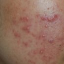 신레이저 이미지