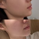 4702 | 강남구청에서 웨딩 앞두고 리베아에스테틱에서 티리온엑스 윤곽관리 받은 후기