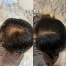 향남두피관리 H.리셀 두피열을 내려주는 힐링코스 두피순환관리