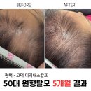 [평택 미리내스칼프] 1년 넘게 멈춘 50대 원형탈모, 5개월 관리 후 머리카락이 올라온 기적