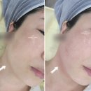 멍짱 | 인모드fx포마 멍 구월동피부과 다녀온 내돈내산 가격후기​