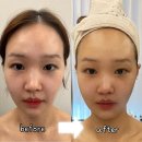 ER-1[동서대로]-하-1 | 대전 알테온 리프팅 모든미에스테틱 1회만으로 얼굴 라인 정리된후기