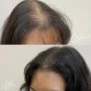 상록바른약국 | 탈모 때문에 트라우마였던 나에게 안산 우디뷰티에서 &#39;두피 염색&#39;으로 극복한 후기!!(분량 多)