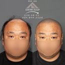 미적공감 | ✂ 결국 흑채를 버리고 삭발을 택한 이유｜부평·인천 탈모인들도 공감할 리얼 후기 (인터뷰 전문)