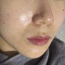 강남역 팔자필러 노안 탈출 대대대만족 후기