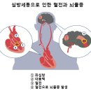 좌심방이 폐색술과 뇌졸중 이미지