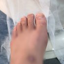 나도손톱 레푸스 개봉점 | [내돈내산] [발 사진 주의] 레푸스 발 관리 후기 (서울대입구역점)