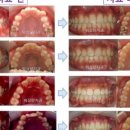 워싱턴치과의원 | 덧니교정, 꼭 이를 빼야 할까요? (비발치교정 실제 기준 공개)