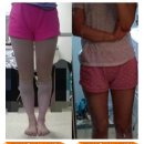 하피스의원 | 지방흡입 - 하피스의원