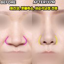 제이티성형외과의원 | 신사코성형외과 퍼진코 비순각교정 콧볼축소 수술 후기