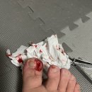 선운우리정형외과의원 - 내성발톱 썰 푼다ㅋㅋ 셀프 발톱 뽑기!