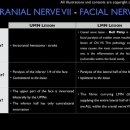 Bell Palsy 이미지