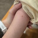 오체안피부과의원 | 어린이 물사마귀 치료_ 닥터딥 멀티에멀젼_ 죽전 미가피부과