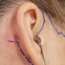 노블성형외과의원 | 학동 성형외과, 안면거상 부작용 카더라 빼고 말해드립니다 <의사 작성>