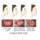 치열 궁 관계 이상[Anomalies of dental arch relationship]치과질환 이미지