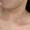 아카데미약국 | 성성동에스테틱 아율린 뷰티 아카데미 쥐젖,편평사마귀 제거 웨딩관리