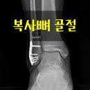 정강한의원 | 깁스 풀 날만 기다리는 발목 복사뼈 골절 환자를 위해, 뼈가 빨리 붙게 돕는 방법