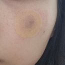 마조로 | [서울 왕십리/샤이니의원]흑자 리팟 레이저 솔직 시술 후기(전후 사진 있음)