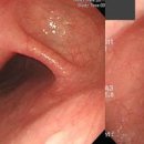 연하곤란 삼킴장애 원인 게실 식도암 경피증 편도선염 이미지
