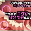 구강암 초기증상 및 예방 이미지