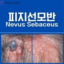 피지선모반(Nevus Sebaceus) 완벽 가이드: 원인·증상·치료 총정리 ㅣ경주피지선모반ㅣ피부과추천
