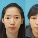 노블앤코의 노블 코성형후기 총집합!!!