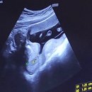 세정인디안타워 | 동탄제일병원 맥수술 임신 14주차 진료 후기 자궁경부무력증센터 박문일교수님(대기시간 주차)