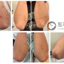 녹번한의원 | 가려움으로 번진 아토피치료 (녹번역한의원 피부한의원 아토피한의원 피부질환 야간진료 응암동한의원)