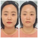 주노뷰티 | [강남역 작은얼굴관리] 원래 내 얼굴형을 되찾아주는 강남뷰티 솔직후기