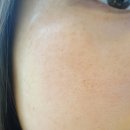 뉴센스의원 | 서울 이대 신촌 에서 피부 관리 잘하는 곳 뉴센스의원 미라클 레이저 시술 받은 후기